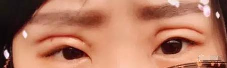 日本纳米无痕双眼皮加开眼角,纳米无痕双眼皮15天恢复图
