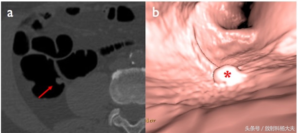 小孩肠镜发现好多小息肉,肠镜发现有息肉应几年做一次肠镜