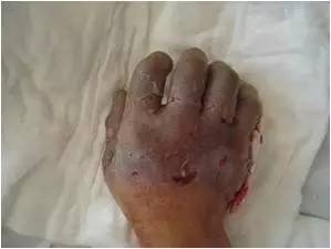 冬天长冻疮的最好方法,冬天治冻疮最好的方法