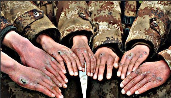 冬天长冻疮的最好方法,冬天治冻疮最好的方法