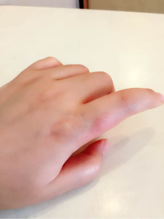 切辣椒后手又辣又热痛是什么病,切完辣椒后手火辣辣的痛