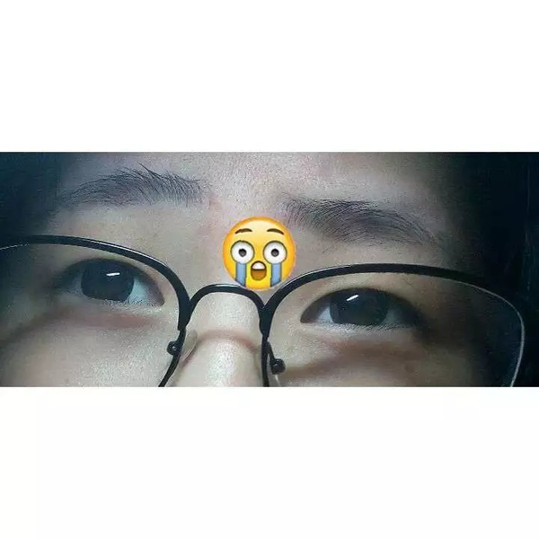 抽脂双眼皮做完眼睛有褶,割双眼皮肿成一条缝