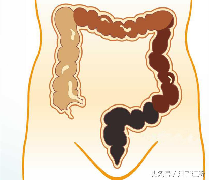 产后便秘把痔疮拉出来了,便秘后肛裂了怎么办