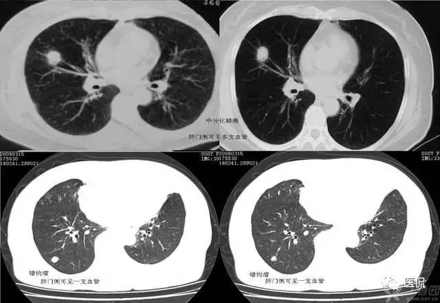 影像学呼吸系统理论知识,呼吸系统疾病影像学常见征象