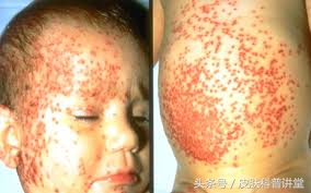皮肤科疱疹,皮肤科一问一答