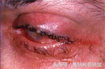 皮肤科疱疹,皮肤科一问一答