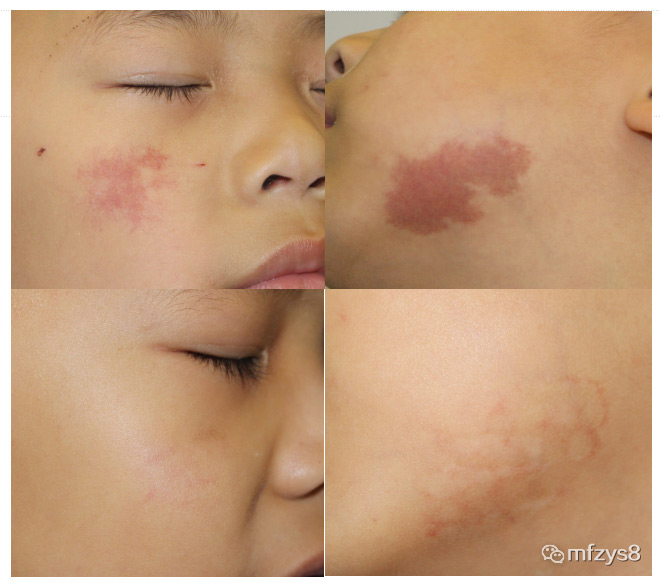 胎记如何治疗才可以不长,胎记能随着年龄的增长而消失吗