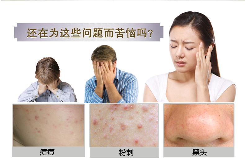 教你如何祛痘,有什么方法祛痘有效最快