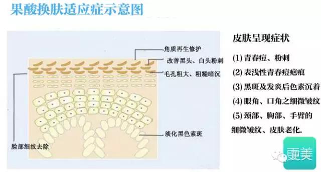 长痘痘好焦虑啊,长痘痘要用什么药治疗