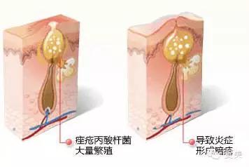 长痘痘好焦虑啊,长痘痘要用什么药治疗