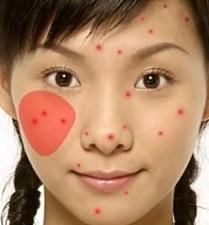 脸上长痘痘是什么原因一碰就疼,脸上长痘痘是什么原因怎么解决