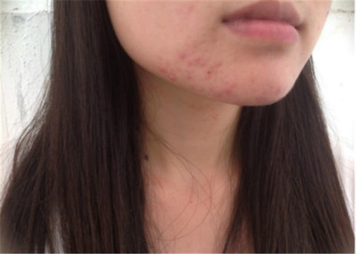 下巴老是长痘痘反反复复怎么办,下巴及两侧长痘痘反反复复怎么办