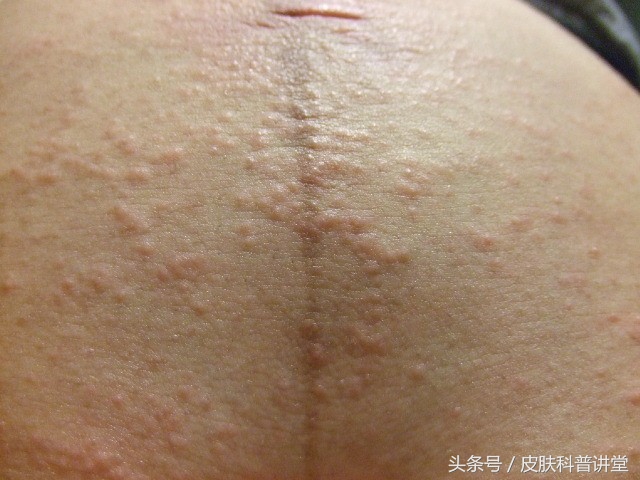 妊娠期瘙痒症,妊娠期特发性痒疹