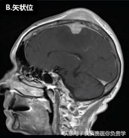 头顶长了包子似的疙瘩是什么,头顶长了个包是肿瘤吗