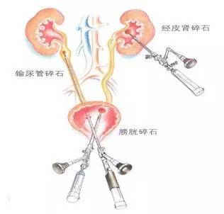 做个手术费用1000块能报多少,做个什么手术大概费用两万