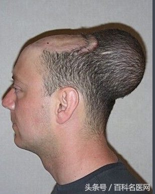 恶性肿瘤身上有很多包是咋回事,身上长个包是恶性的是什么意思