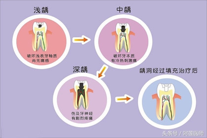 龋齿修复了又复发怎么办,龋齿处理了还疼