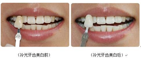 牙齿冷光美白一次就能变白吗,冷光美白牙齿您了解的有多少