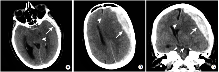 多图颅内出血影像学表现大全,头被撞后颅内出血有什么表现