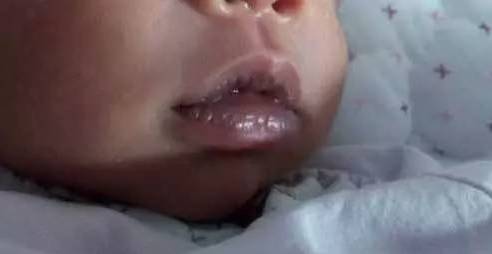 嘴唇上有几种颜色是什么病,嘴唇肿要警惕四种慢性病