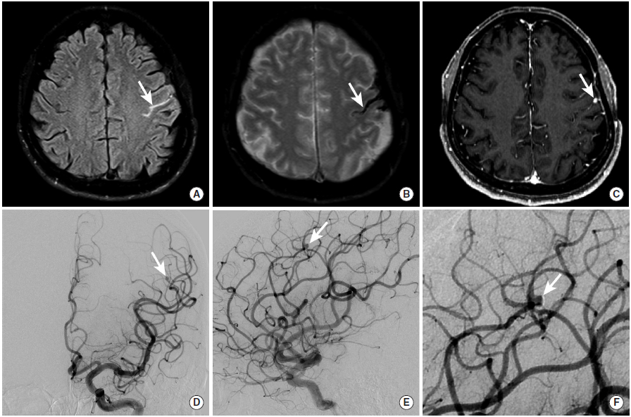 多图颅内出血影像学表现大全,头被撞后颅内出血有什么表现