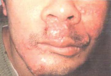 红色斑丘疹是湿疹吗,红斑丘疹误诊湿疹