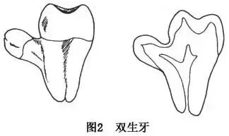 儿童少一颗乳牙会有影响吗,孩子少长一颗牙怎么回事