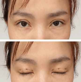 韩式三点定位双眼皮需要忌嘴么,三点定位双眼皮为啥叫韩式双眼皮