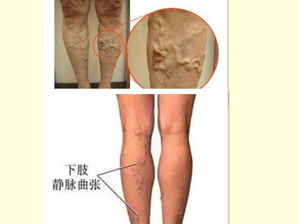 蚯蚓腿静脉曲张外用药,蚯蚓脚治疗静脉曲张