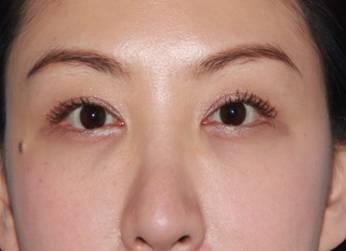 想要双眼皮就双眼皮吗,眼睛小割双眼皮是不是会好看很多