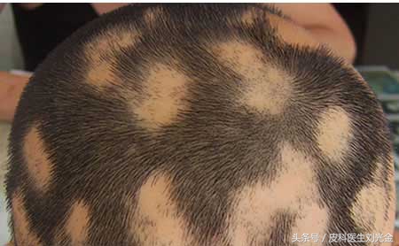 鬼剃头是不是肾亏,鬼剃头是身体缺什么导致的