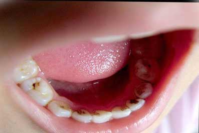 为什么牙齿缝隙发黑,牙龈牙齿交界处发黑