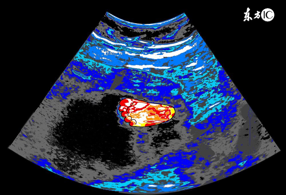 孕妈检查太多有哪些可以不做的,孕妈产检正常就表示宝宝没有缺陷