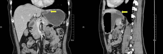 当EUS遇到“假瘤子”(二)——都是“隔壁老王”惹的祸(毗邻外压)