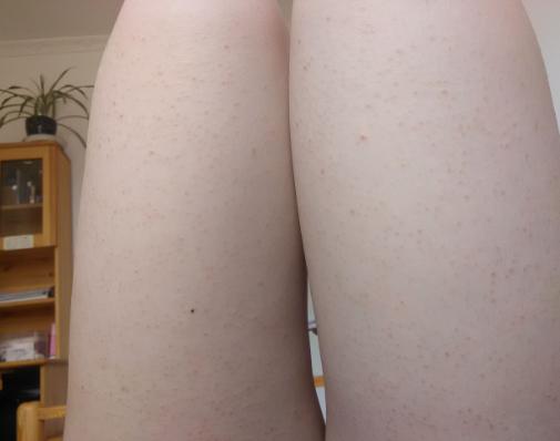 自制祛鸡皮肤的偏方,胳膊上鸡皮肤消除偏方