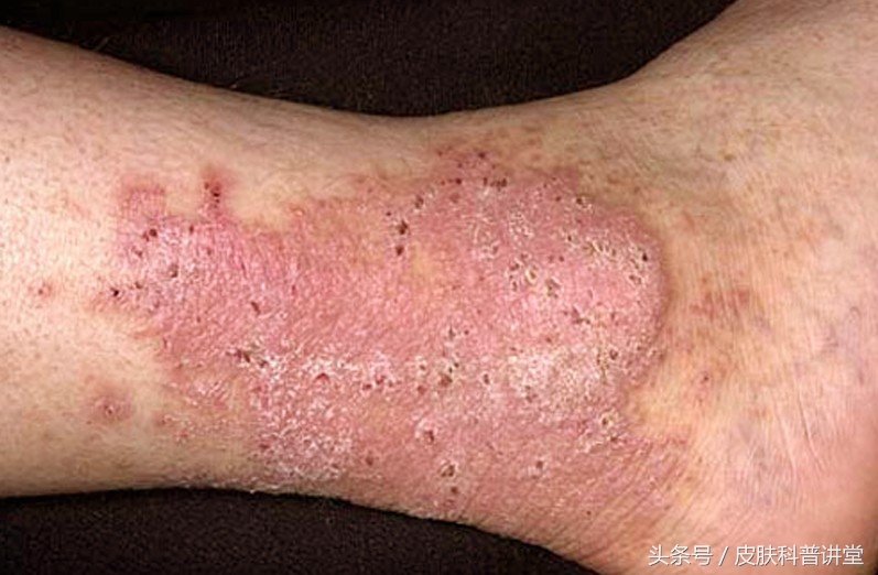 反复神经性皮炎是缺什么,神经性皮炎反反复复如何根除