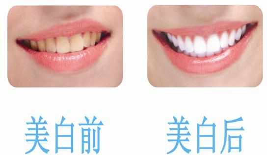 洗牙真的能让牙齿美白吧,洗牙补牙美白牙齿一次性搞定