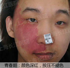 为什么红胎记会突出皮肤表面,光动力治红胎记失败