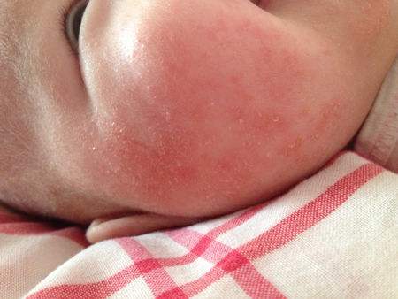 孩子脸上有像蜘蛛红色血丝,小孩脸上红色血丝怎么回事