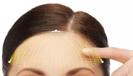 自体脂肪丰额头的案例,自体脂肪丰额头效果如何