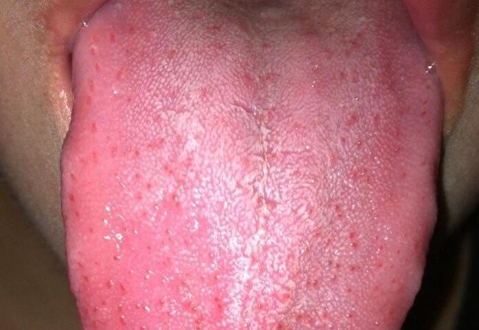 舌头反映心脏健康，淤斑、发红说明心脏有疾病了！