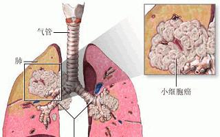 肺癌最严重的是小细胞吗,小细胞肺癌肺癌特征