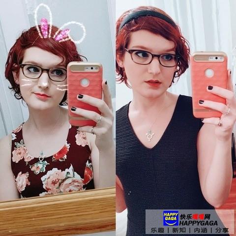 雌激素治脱发,雄性激素脱发补充雌性激素有用吗