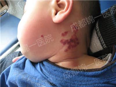 鲜红斑痣到底需不需要治疗？这个难题有答案了