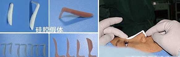 隆鼻价格一览表了解下不花冤枉钱,隆鼻价目表曝光及案例