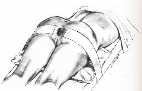 十男九痔，十女九痔？治痔疮的手术能有多疼，难想象！