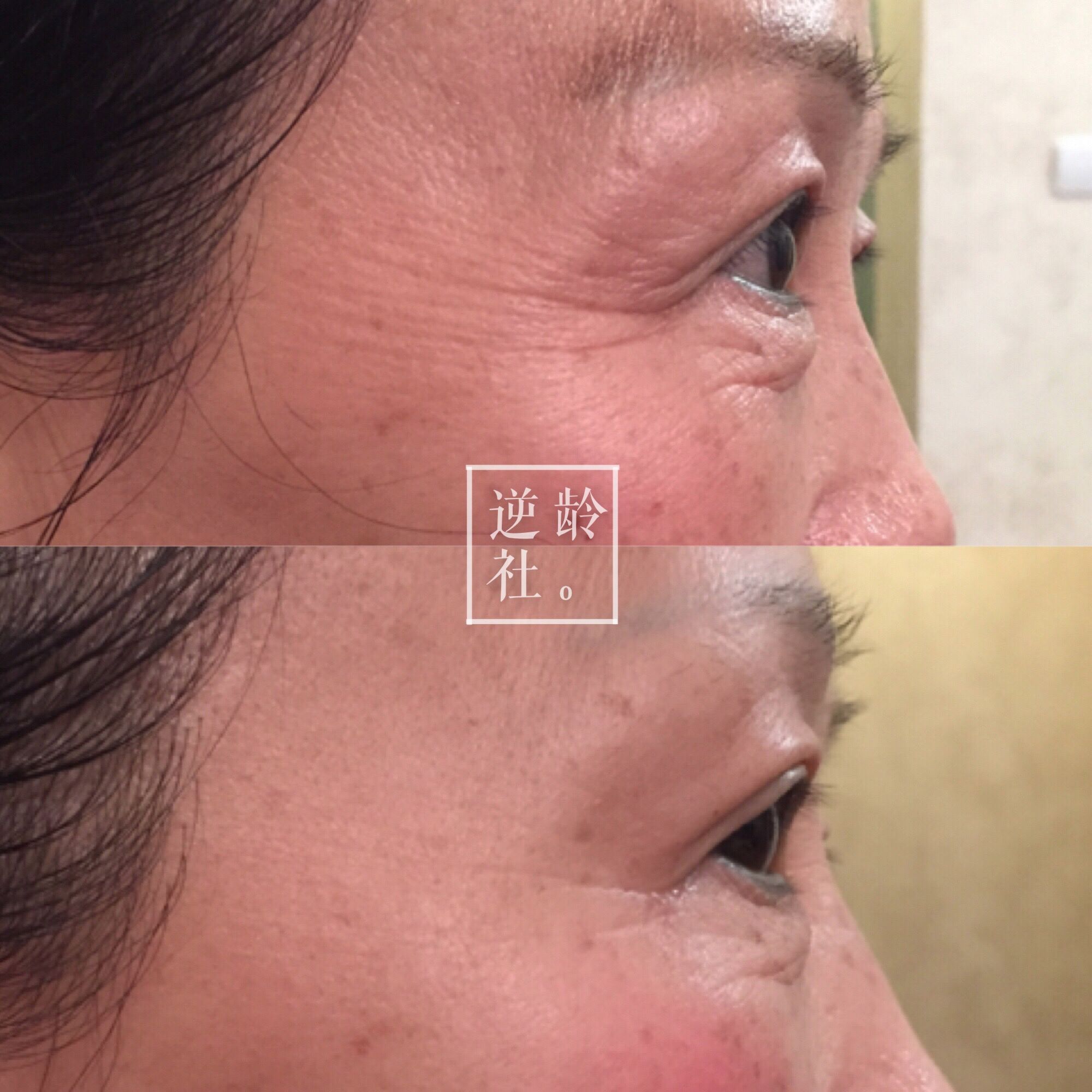 已经做了超声刀如何补救,逆龄精雕好还是超声刀好