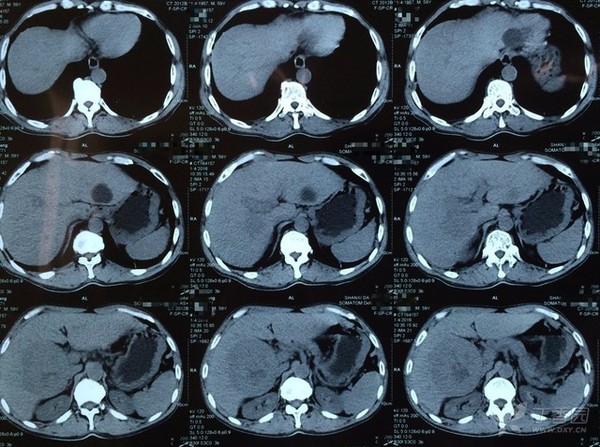 贲门癌转移肝癌4期是什么程度,得了贲门癌和肝癌能活多久