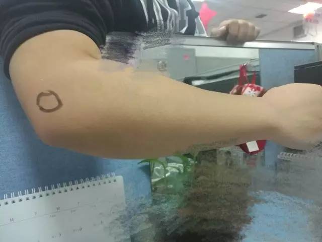 答疑(14):肿胀的滑膜容易再次受伤