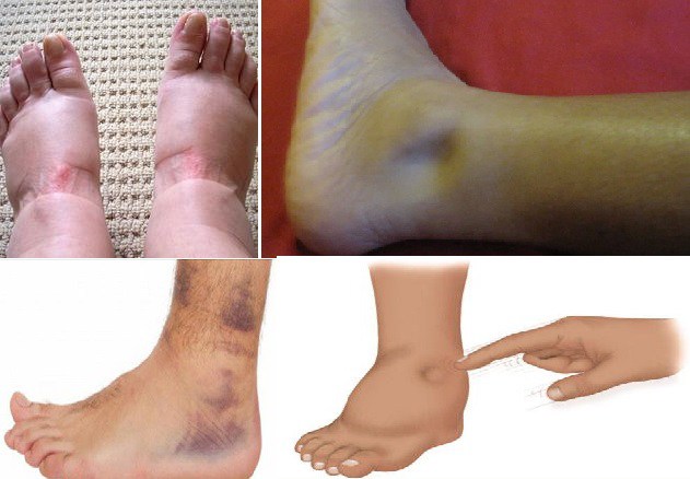 出现身体水肿,静脉回流障碍而发生水肿的原因是